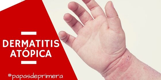 eccema, eczema, dermatitis,