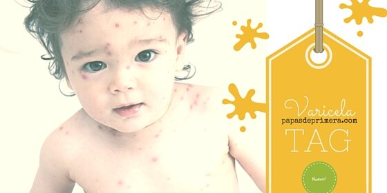 Tuvo Varicela