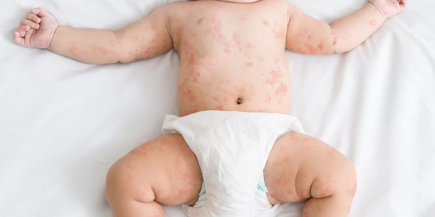 AdobeStock_266373350 Sarampión