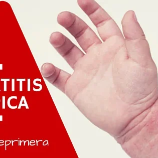 Dermatitis atópica o eccema en la piel del bebé