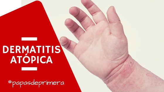 Dermatitis atópica o eccema en la piel del bebé