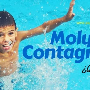 Molusco contagioso en la piel de los niños